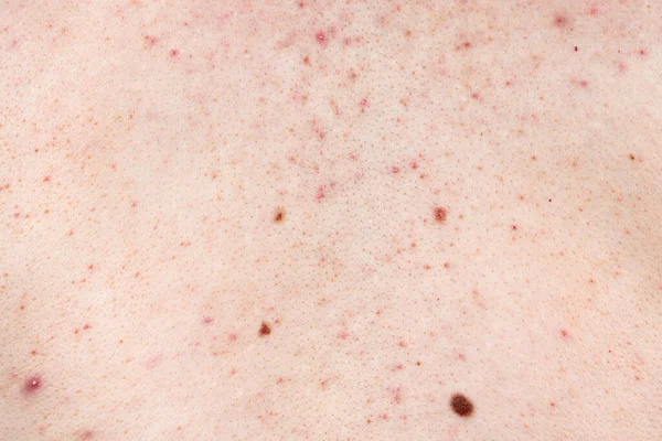 Skin Background Texture Pimples Blackheads Problematic Skin Close Acne Diseases — Stock Photo, Image