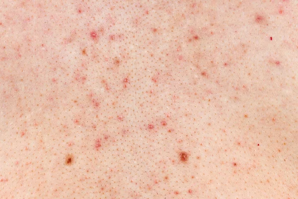 Skin Background Texture Pimples Blackheads Problematic Skin Close Acne Diseases — Stock Photo, Image