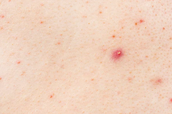 Skin Background Texture Pimples Blackheads Problematic Skin Close Acne Diseases — Stock Photo, Image