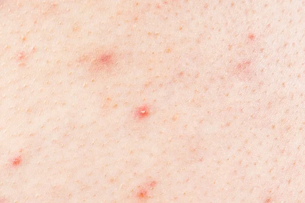 Skin Background Texture Pimples Blackheads Problematic Skin Close Acne Diseases — Stock Photo, Image