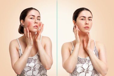 Portrait of a young pretty caucasian woman showing redness and inflamed blood vessels on her cheeks. Beige background. The concept of rosacea, before and after. clipart