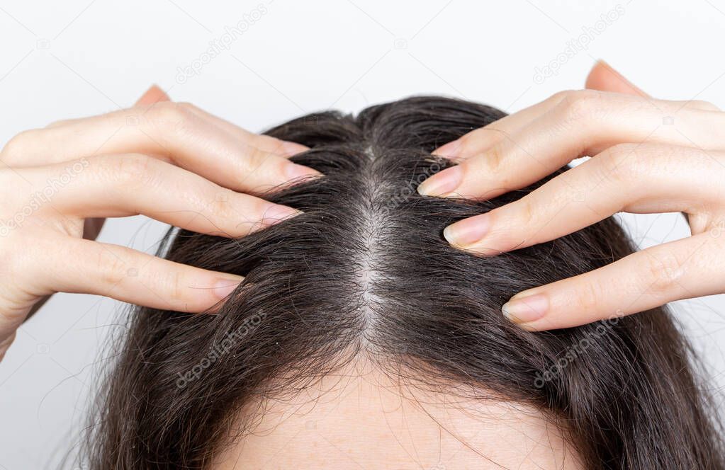 Dandruff and hair problems. The woman scratches her scalp with her hands, showing dark hair with dandruff. White background.