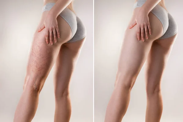 Medicine and varicose veins. A young woman of athletic build is holding her leg with her hand, with a varicose mesh on her thigh. Before and after.