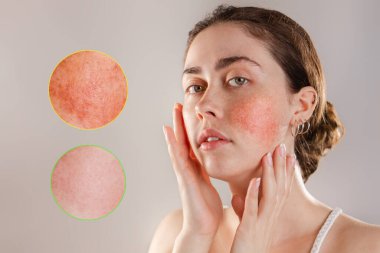 Tıp ve kozmetoloji. Yanaklarında rosacea olan güzel esmer bir kadının portresi. Enflamasyon odaklı büyütülmüş görüntüler. Öncesi ve sonrası.