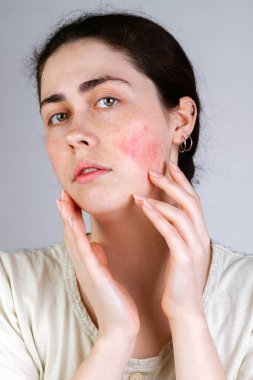 Portrait of a young Caucasian woman showing redness and inflamed blood vessels on her cheeks. Gray background. The concept of rosacea and couperose. Close up. clipart