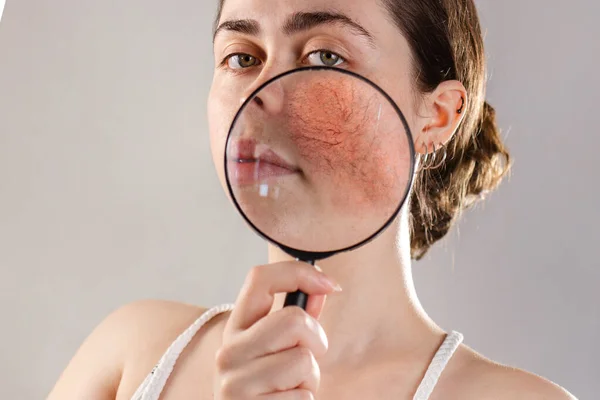 Cosmetología Rosácea Una Joven Sostiene Una Lupa Cerca Cara Mostrando — Foto de Stock