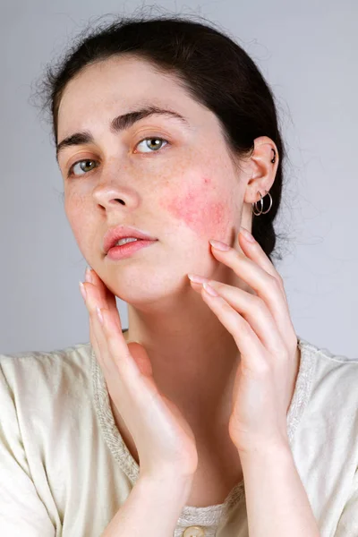 Portrait Young Caucasian Woman Showing Redness Inflamed Blood Vessels Her — Stock Photo, Image