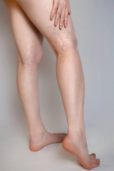 Varicose Veins Concept Female Legs Varicose Veins Vasodilatation — Stock Photo, Image