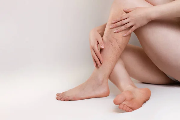 Concetto Malattia Varicosa Medicina Donna Siede Gambe Incrociate Con Vene — Foto Stock