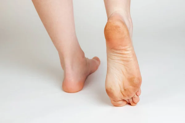Female Feet Corns Calluses White Background Foot Close Cosmetology Medicine — Stock Photo, Image