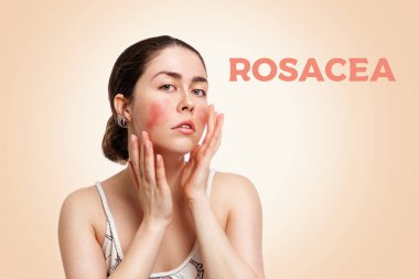 Portrait of a young Caucasian woman showing redness and inflamed blood vessels on her cheeks. The inscription rosacea. Beige background. The concept of rosacea and couperose. clipart