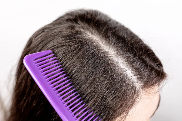 Woman Brunette Parted Her Hair Comb Shows Dandruff Close View — Stock Photo, Image