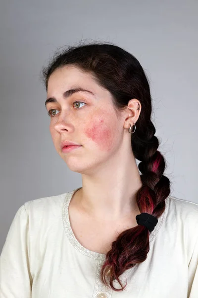 Portrait Young Caucasian Woman Showing Redness Inflamed Blood Vessels Her — Stock Photo, Image