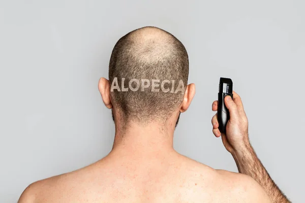 Mannelijke Alopecia Een Man Met Dunner Wordend Haar Houdt Een — Stockfoto