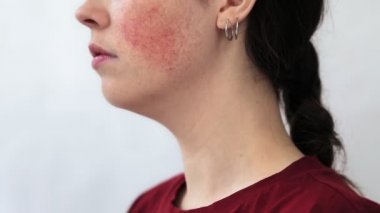 Yanağında büyük bir kızarıklık olan genç bir kadının portresi. Beyaz arka plan. Rosacea ve couperose konsepti