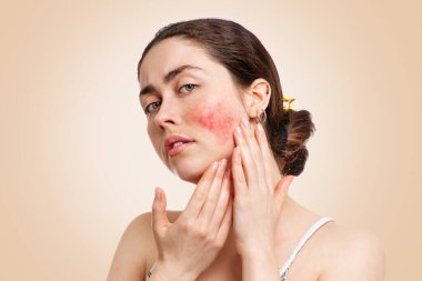 Portrait of a young pretty Caucasian woman who frowns and shows reddened and inflamed cheeks. Beige background.The concept of rosacea, healthcare and couperose. clipart