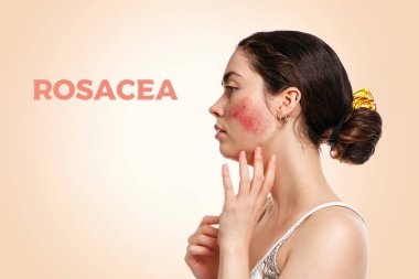 Portrait of a young beautiful Caucasian woman with reddened and inflamed blood vessels on her cheeks.Beige background. Side view.The inscription ROSACEA.The concept of rosacea, couperose and healthcare. clipart