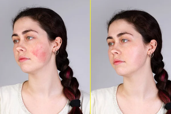 Portrait Young Caucasian Woman Red Inflamed Blood Vessels Her Cheeks — Stock Photo, Image