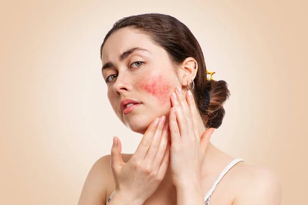 Kaşlarını çatan, kızartılmış ve yanakları iltihaplanmış genç beyaz bir kadının portresi. Bej arka plan. Rosacea, sağlık ve couperose kavramı..
