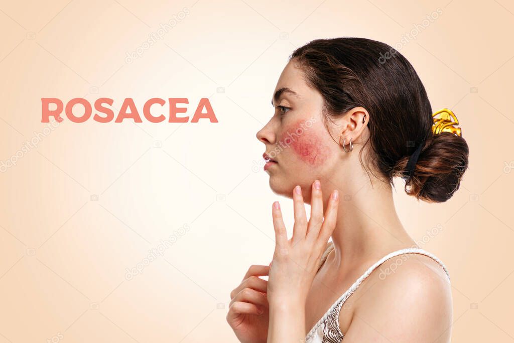 Portrait of a young beautiful Caucasian woman with reddened and inflamed blood vessels on her cheeks.Beige background. Side view.The inscription ROSACEA.The concept of rosacea, couperose and healthcare.