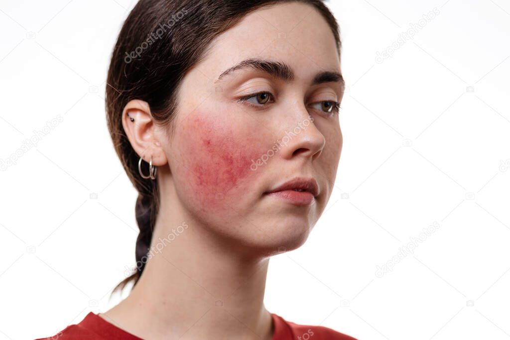 Portrait of a young caucasian woman in close-up showing rosacea on her cheeks. White background. Rosacea and inflammation on the face.