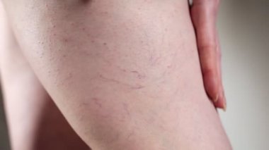 Kafkasyalı bir kadın ellerini vasküler yıldız işaretleriyle bacaklarının üzerinden geçirir. Beyaz arka plan. Kapatın. Varisli damar ve tedavi kavramı.