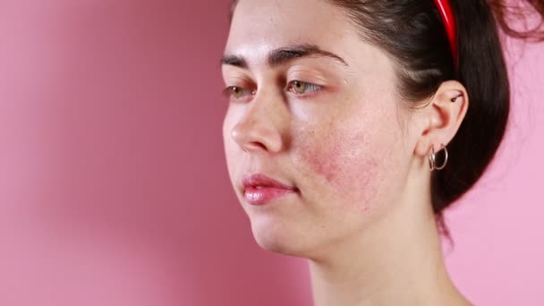 一个年轻的白种人美女的脸在特写中表现出发炎和咳嗽 粉色背景 灵丹妙药的概念 — 图库视频影像