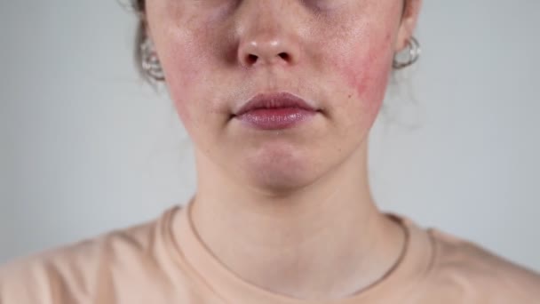 Zbliż Portret Młodej Białej Kobiety Zaczerwienieniem Zapaleniem Naczyń Krwionośnych Policzkach — Wideo stockowe