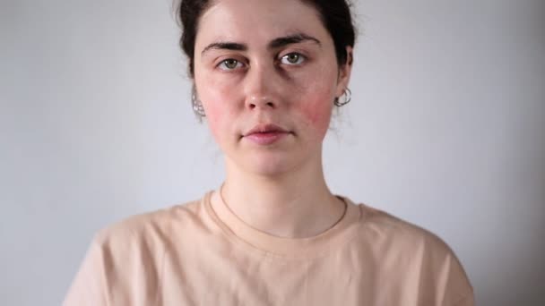 Portrait Young Caucasian Woman Showing Redness Inflamed Blood Vessels Her — Stock Video