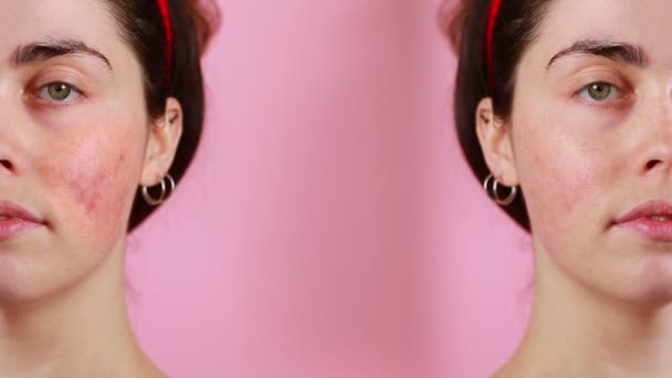 酒さの前と後の結果を示すクローズアップで若い白人女性の顔の2つの半分 分割画面 ピンクの背景 クーペと酒の概念 — ストック動画