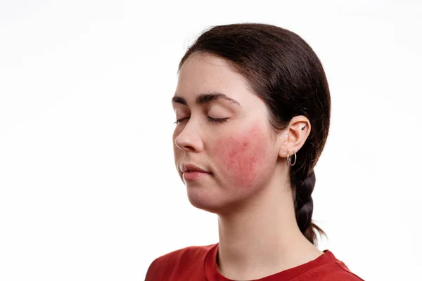 Yanaklarında Rosacea Olan Gözleri Kapalı Beyaz Bir Kadının Portresi Beyaz — Stok fotoğraf