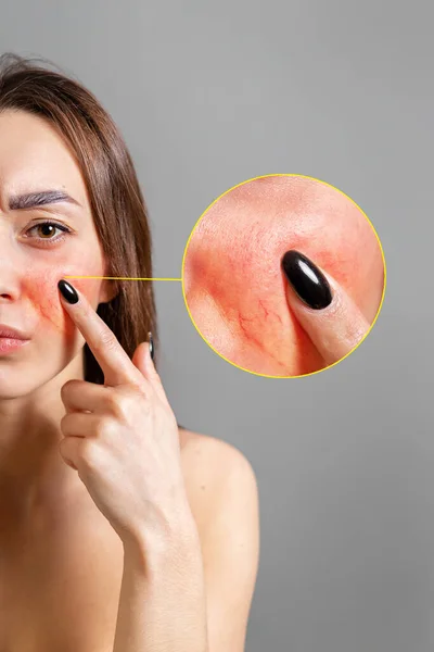 灵丹妙药的概念一个白人黑发女人用手指指着红脸发炎 复制空间 变焦圈显示皮肤问题 垂直的 灰色背景 — 图库照片