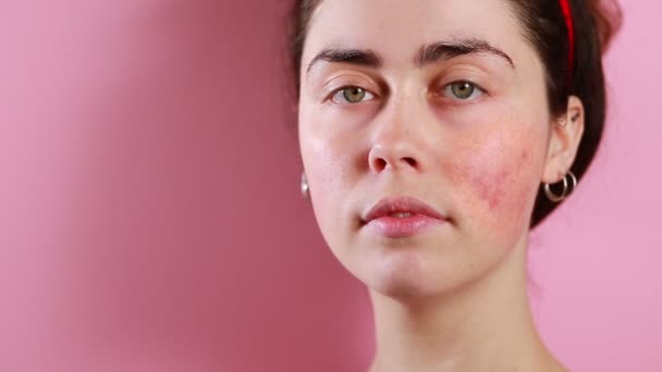 Närbild Porträtt Ung Vit Vacker Kvinna Visar Inflammation Och Couperose — Stockvideo