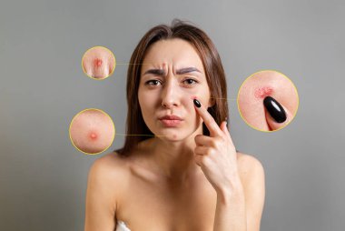 Kozmetoloji, cilt bakımı ve sivilceler. Genç bir Kafkasyalı esmer, yüzündeki sivilceyi işaret ediyor. Gri arka plan. Çemberde cilt problemleri var. Boşluğu kopyala.
