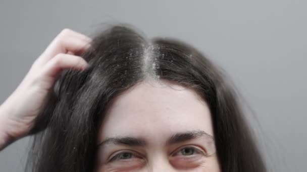 Woman Strongly Scratches Her Head Her Hands Dark Hair Dandruff — Stock Video