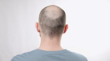 Alopecia hastası bir adam eliyle başını okşuyor. Dikiz aynası. Kellik ve sağlık sorunları kavramı