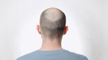 Alopecia hastası bir adam eliyle başını okşuyor. Dikiz aynası. Beyaz arka plan. Kellik ve sağlık sorunları kavramı