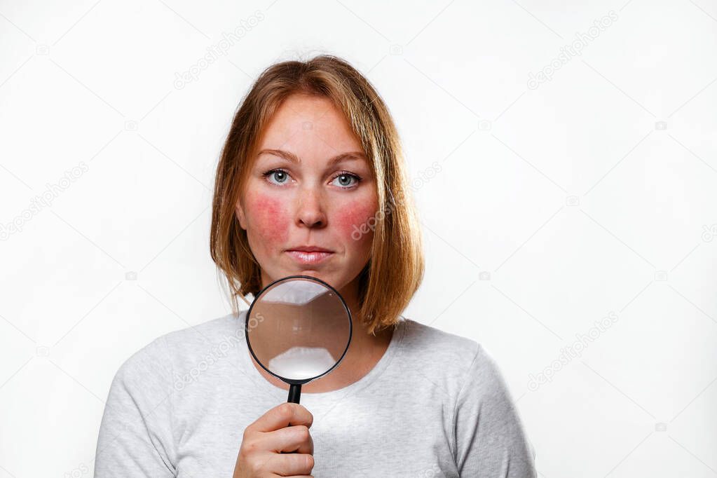 Portrait of a young woman showing redness on her cheeks, with a magnifying glass. Copy space. White background. The concept of rosacea.