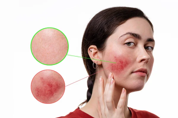 Portrait Young Woman Showing Rosacea Her Cheeks Her Hand Circles — Stock Photo, Image