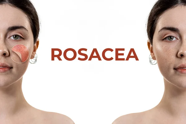 Dry Gritty Eyes After 50? Ocular Rosacea May Be Why