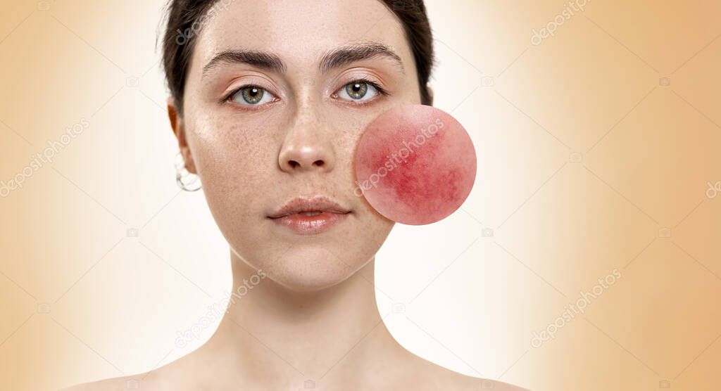 Close-up portrait of a beautiful young woman, with an zoomed circle on her cheek, showing inflamed blood vessels. Beige background. Rosacea treatment concept.