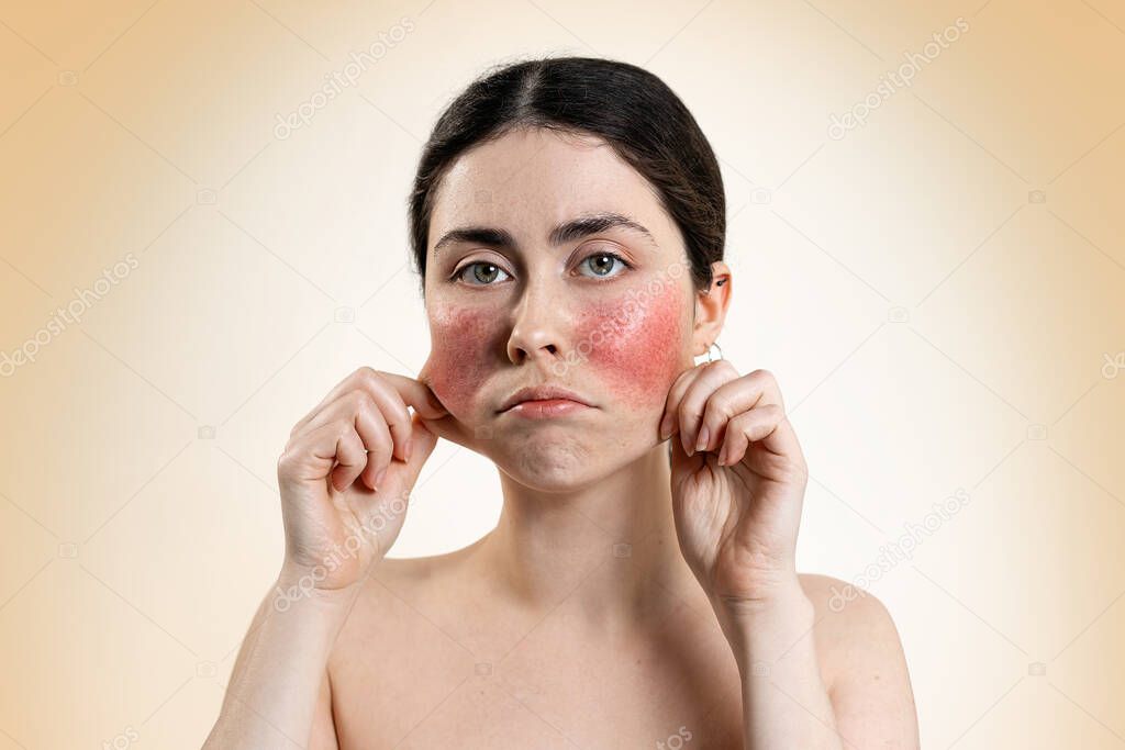 Portrait of a distressed caucasian woman, pulling the skin on her reddened cheeks with her hands. Beige background. The concept of treatment of rosacea.