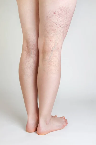 Concept Varicose Veins Cosmetic Treatment Female Legs Vascular Asterisks Rear — Stock Photo, Image