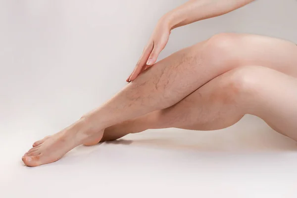 Koncepcja Choroby Żylaków Kosmetologii Kobieta Wdziękiem Krzyżuje Nogi Gwiazdami Naczyniowymi — Zdjęcie stockowe