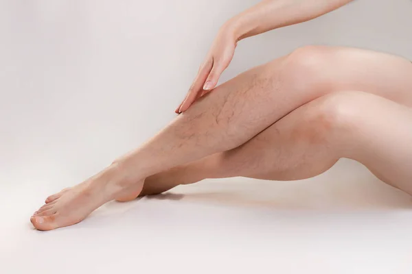 Concetto Malattia Varicosa Cosmetologia Donna Incrocia Con Grazia Gambe Con — Foto Stock