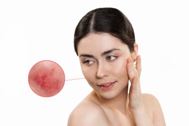 Rosacea. Portrait of a beautiful woman, with an enlarged image of redness in a circle. The concept of skin care and treatment. clipart