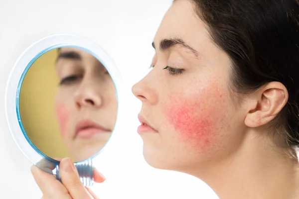 Yanağında rosacea olan güzel genç bir kadın aynaya bakıyor. Beyaz bir arka planda izole edilmiş. Estetik tıp ve couperose konsepti.