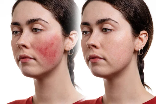 Two Close Portraits Young Caucasian Woman Rosacea Her Cheeks White — Stock Photo, Image