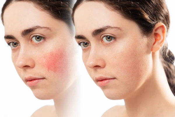 Rosacea Two Beautiful Young Female Faces Close White Background Showing — Stock Photo, Image
