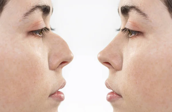鼻形成前と後の結果を示す2人の女性の顔をクローズアップ サイドビュー 白地だ 鼻形成術の概念 — ストック写真